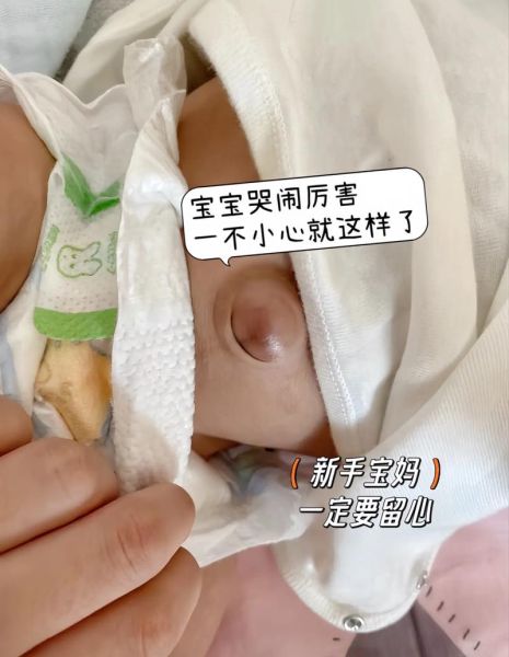 满月宝宝肚脐出血怎么办_满月宝宝肚脐出血正常吗