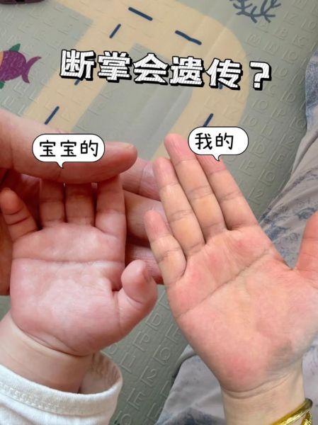 宝宝左手断掌代表什么_需要看医生吗