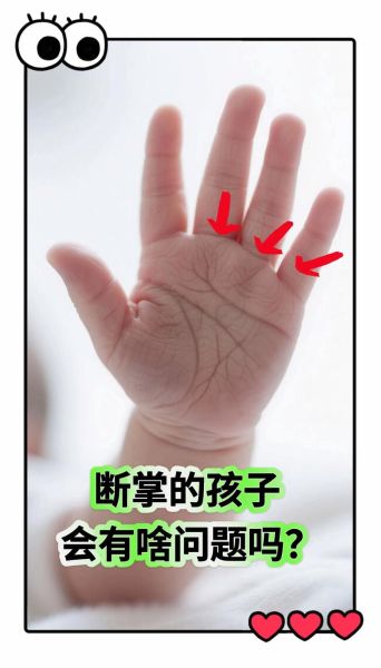 宝宝左手断掌代表什么_需要看医生吗