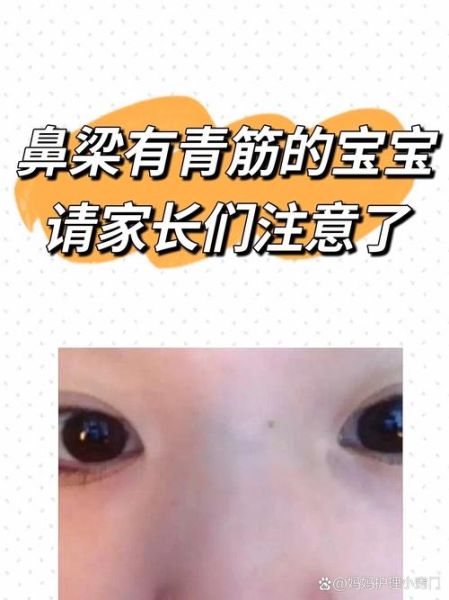 宝宝鼻梁青怎么回事_宝宝鼻梁青需要看医生吗