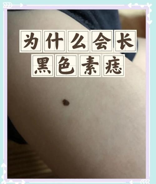 2岁宝宝脸上为什么突然长痣_婴儿色素痣会自己消失吗