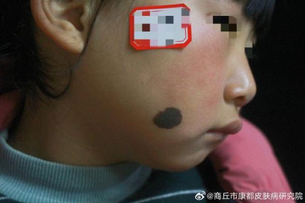 2岁宝宝脸上为什么突然长痣_婴儿色素痣会自己消失吗