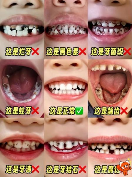 牙齿照片图片大全_如何辨别牙齿问题