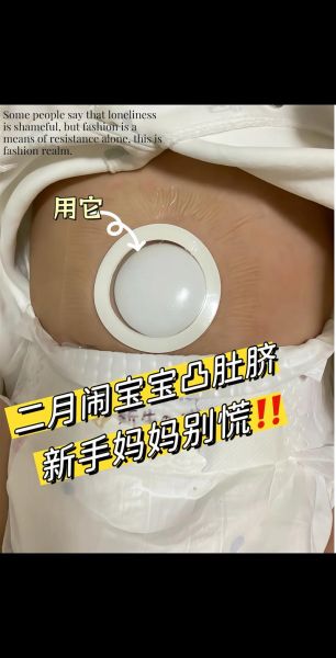 宝宝脐疝怎么办_脐疝会自愈吗