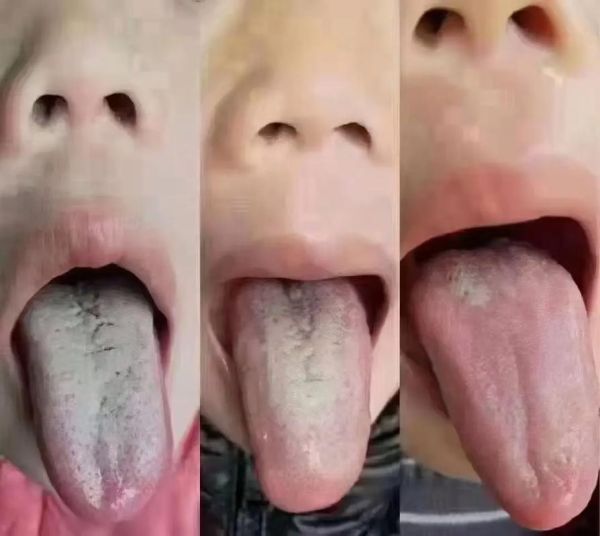 2岁宝宝舌苔厚白是怎么回事_舌苔厚白需要看医生吗
