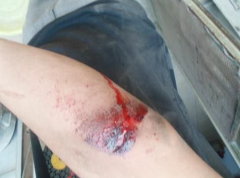 梦到自己手臂受伤流血_周公解梦