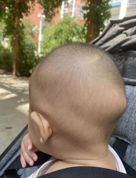 1岁半宝宝摔到后脑勺怎么办_需要去医院吗