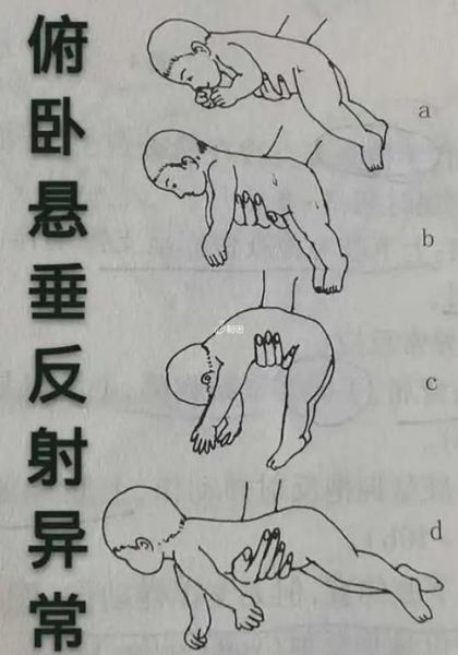 宝宝脑瘫早期症状有哪些_八个动作筛查图怎么看