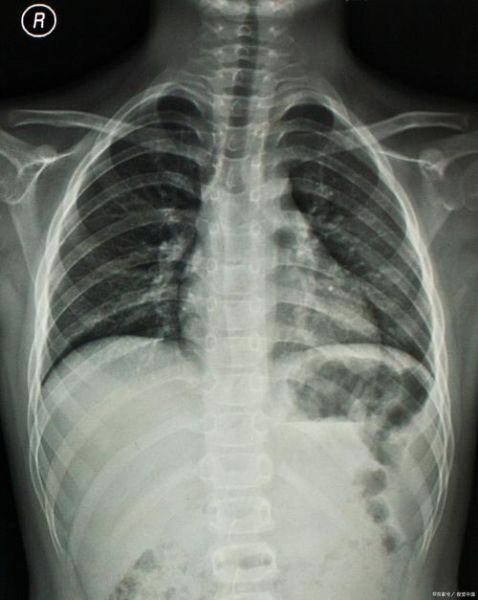 梦到肋骨断了_是什么预兆