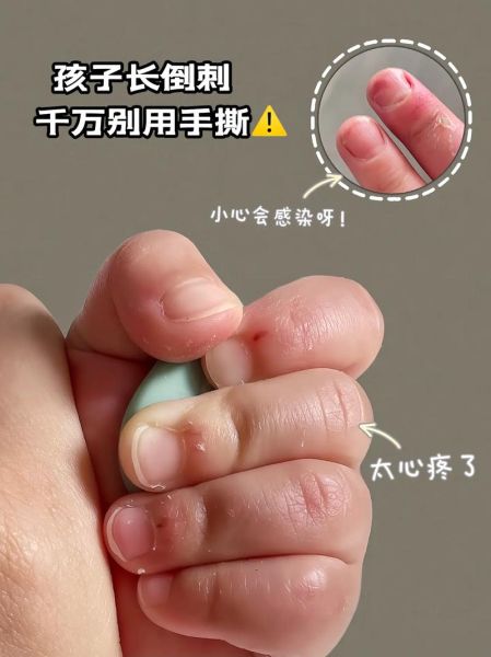 宝宝手上倒刺怎么办_如何预防宝宝倒刺