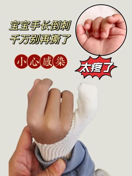 宝宝手上倒刺怎么办_如何预防宝宝倒刺