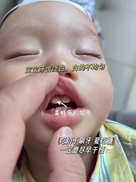 14个月宝宝牙齿有白斑怎么办_宝宝牙齿白斑会掉吗