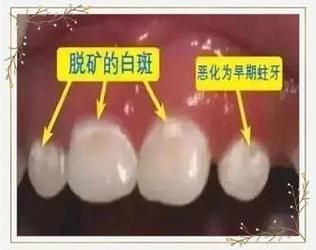 14个月宝宝牙齿有白斑怎么办_宝宝牙齿白斑会掉吗