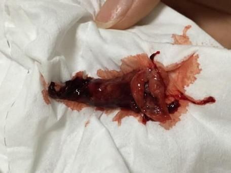 梦到做人流是什么意思_梦见做人流预示什么