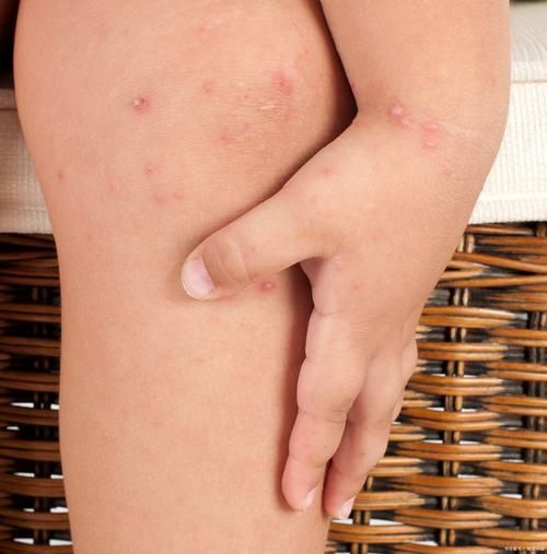 荨麻疹图片大全_荨麻疹初期症状图片