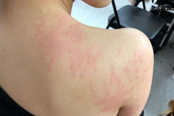 荨麻疹图片大全_荨麻疹初期症状图片