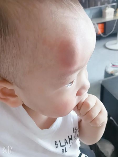 宝宝磕到头起包了怎么办_冰敷还是热敷