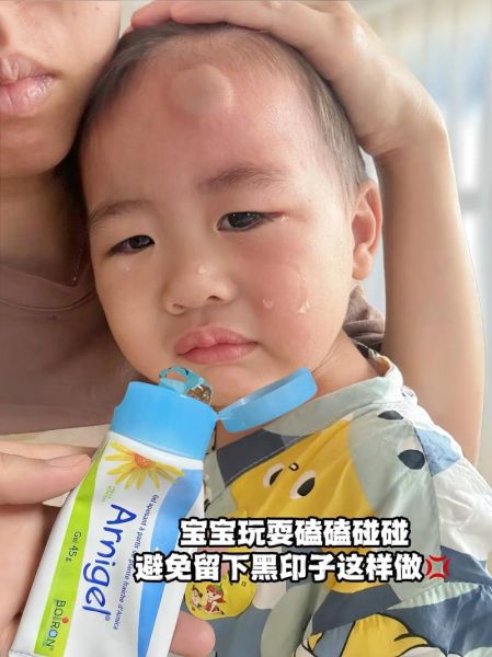 宝宝磕到头起包了怎么办_冰敷还是热敷