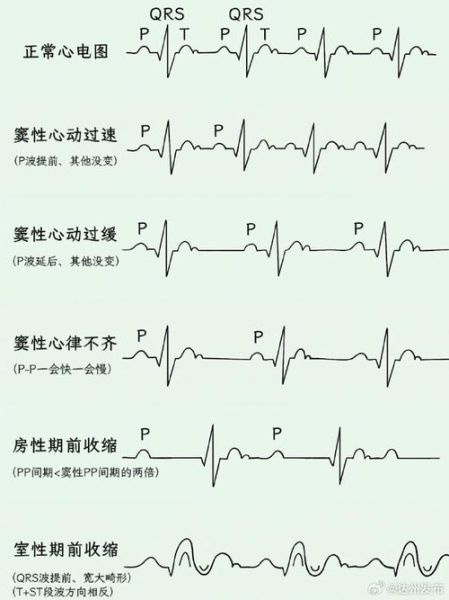 心电图怎么看_正常心电图图片大全
