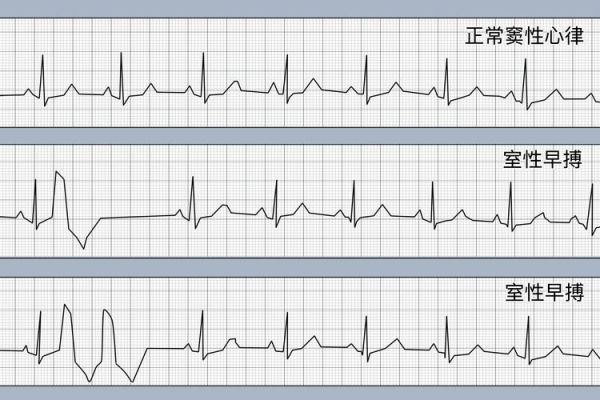 心电图怎么看_正常心电图图片大全