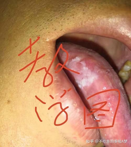 梅毒初期症状图片_梅毒皮疹图片大全