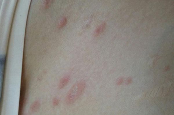 梅毒初期症状图片_梅毒皮疹图片大全