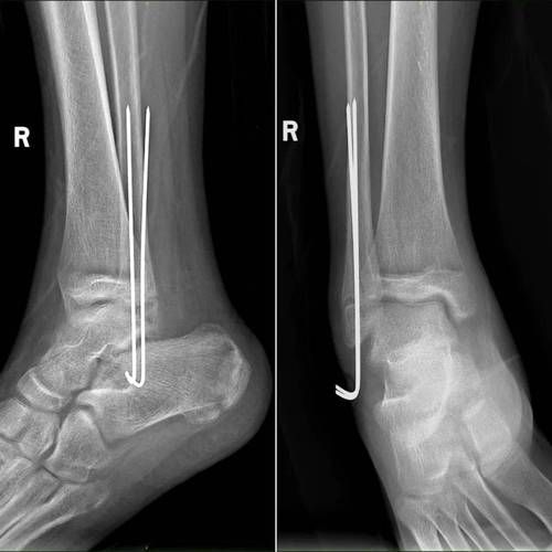 骨折图片大全_骨折类型有哪些