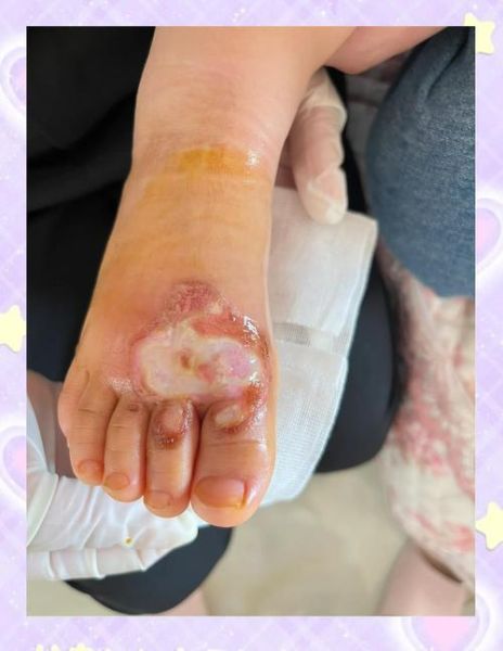 宝宝脚烫了怎么办_宝宝脚烫伤后如何护理