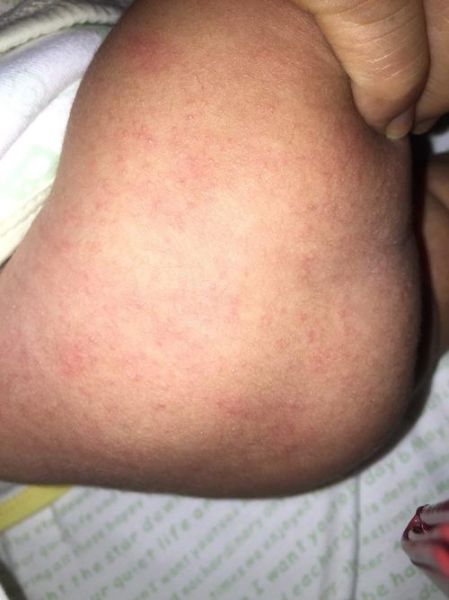 宝宝大腿外侧起红疹子怎么办_婴儿大腿外侧红疹子原因