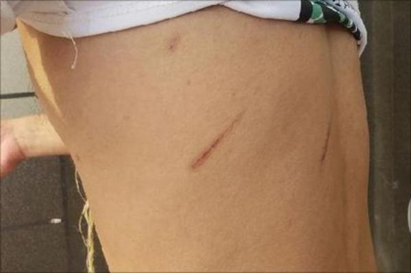 梦到自己受伤了_意味着什么