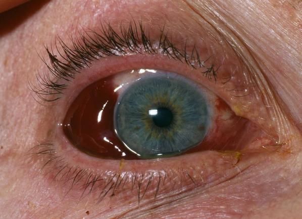 梦见眼睛流血_意味着什么