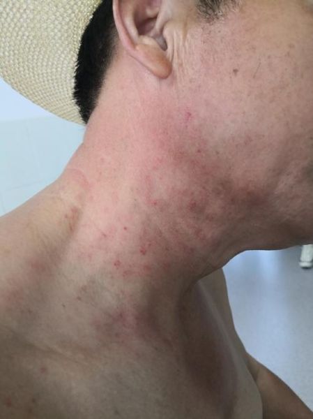 过敏图片大全_如何快速识别常见过敏症状