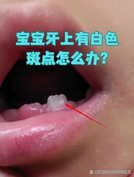 宝宝牙齿有白斑怎么办_如何预防宝宝牙齿白斑