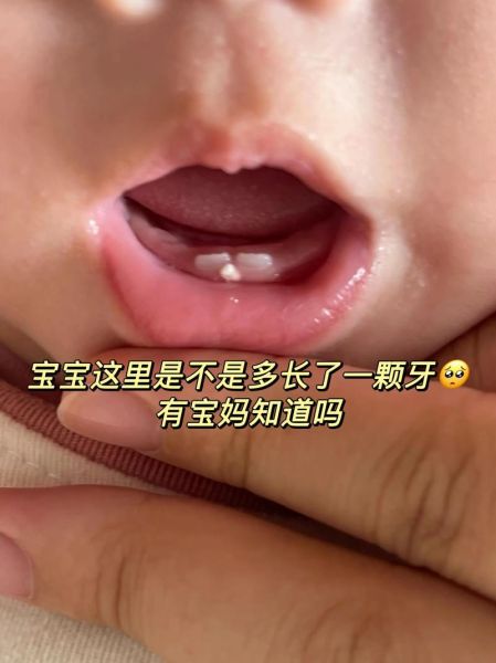 宝宝牙齿有白斑怎么办_如何预防宝宝牙齿白斑