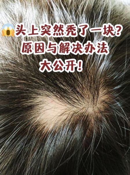 梦到自己秃顶_是什么预兆