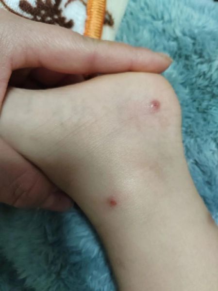 宝宝身上长小水泡怎么办_宝宝长水泡会传染吗