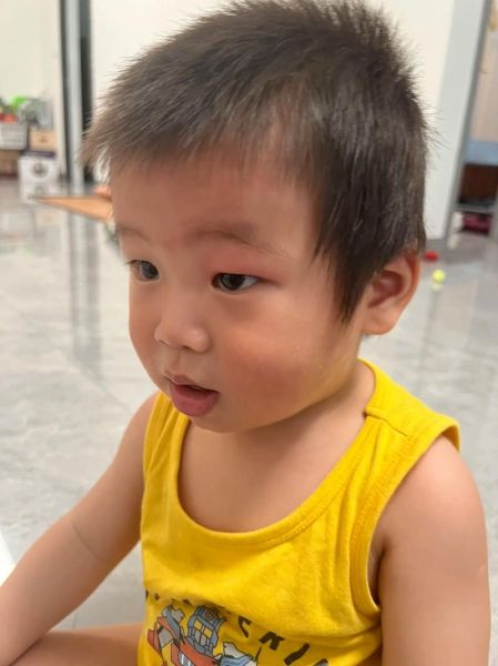 宝宝眼睛被蚊子叮肿了怎么办_怎么快速消肿