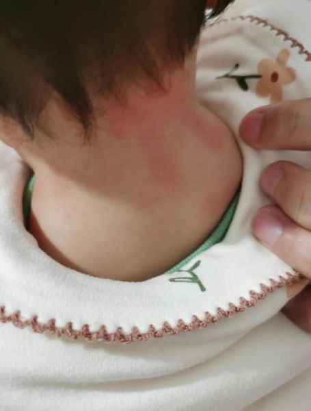 8个月宝宝能吃蛋清吗_蛋清过敏怎么办