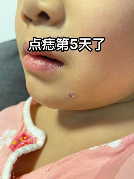 宝宝无色素痣会自己消失吗_宝宝无色素痣怎么治疗