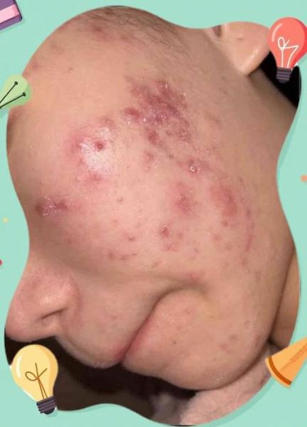 梦到长痘是什么意思_如何破解