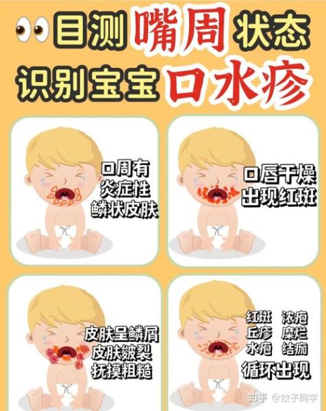 宝宝嘴巴周围长湿疹怎么办_婴儿口周湿疹怎么护理
