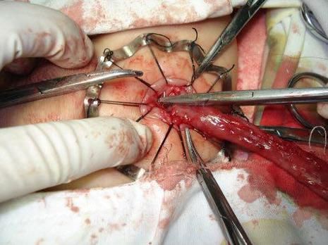 巨肠结的宝宝什么症状_新生儿巨肠结有哪些表现