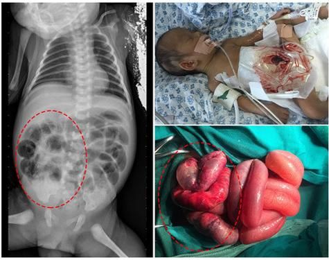 巨肠结的宝宝什么症状_新生儿巨肠结有哪些表现