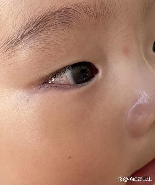 宝宝眼睛有红血丝怎么办_宝宝眼睛红血丝原因