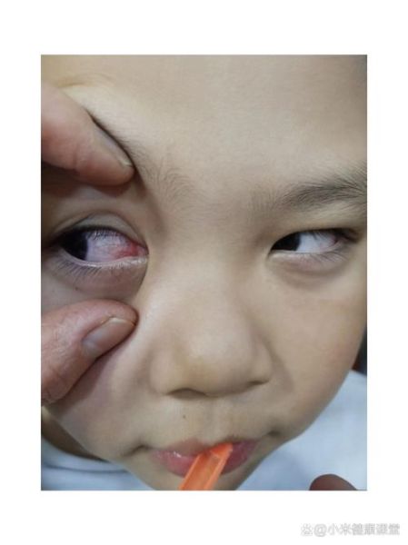 宝宝眼睛有红血丝怎么办_宝宝眼睛红血丝原因