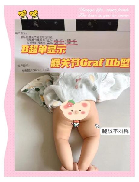 宝宝腿纹不对称图片怎么看_腿纹不对称正常吗