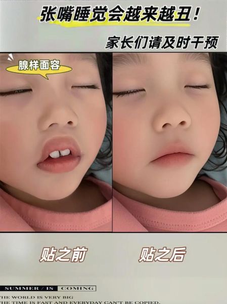 宝宝上嘴唇翘怎么矫正_婴儿翘唇纠正方法