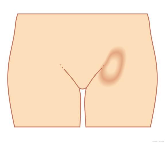 男宝宝疝气的症状图片_婴儿腹股沟疝气怎么判断