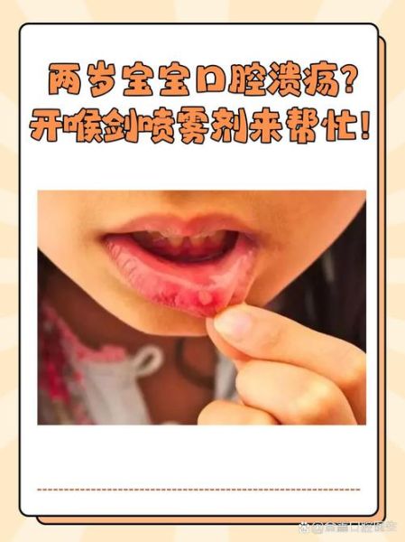 2岁宝宝口腔溃疡怎么办_家庭护理小妙招