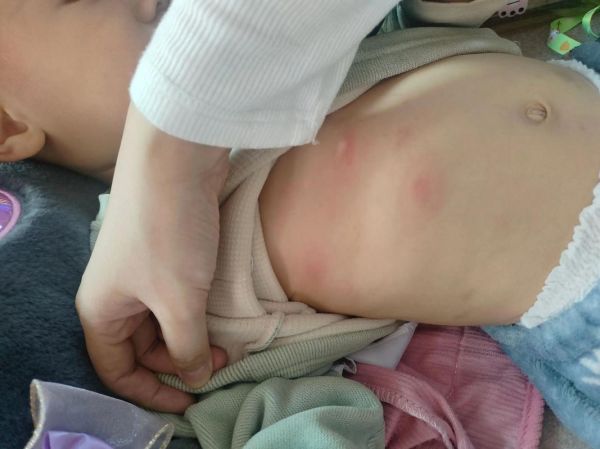 宝宝身上长包怎么回事_宝宝身上长包怎么办